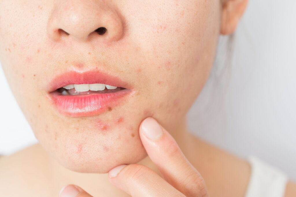 The Curse of Hormonal Acne Tips and Prevention