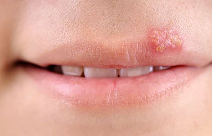 How to treat your cold sores